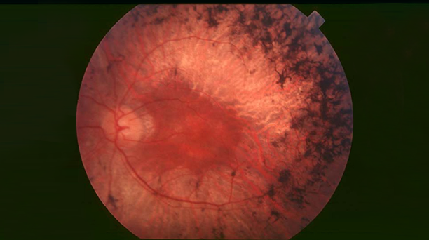 망막색소변성증 이미지