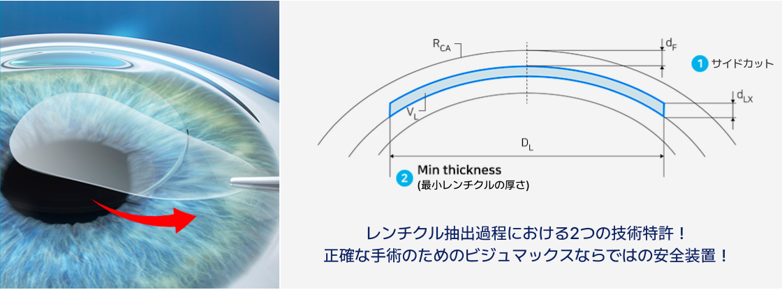 特許取得済みのサイドカット技術