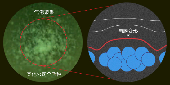 气泡聚集 角膜变形