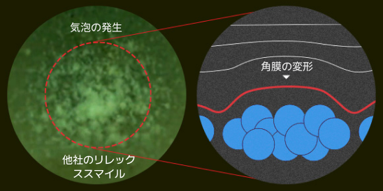 气泡聚集 角膜变形