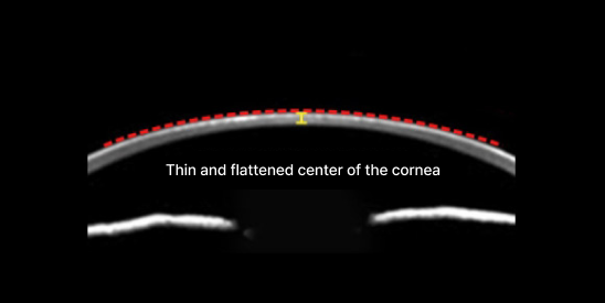 라식, 라섹으로 각막 절삭 후 각막 중심부가 얇아지고 평평해진 경우 이미지 
