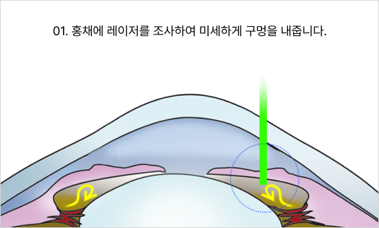 01. 홍채에 레이저를 조사하여 미세하게 구멍을 내줍니다.