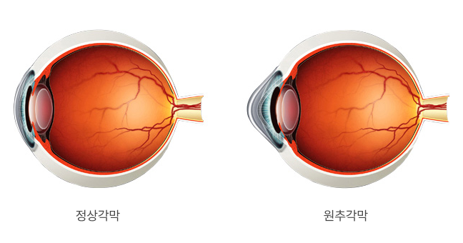정상각막 원추각막